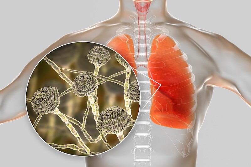 Pulmonary aspergillosis, invasion of a lung tissue by mold fungi Aspergillus with closeup view of the fungi, 3D illustration. Covid-19 complication